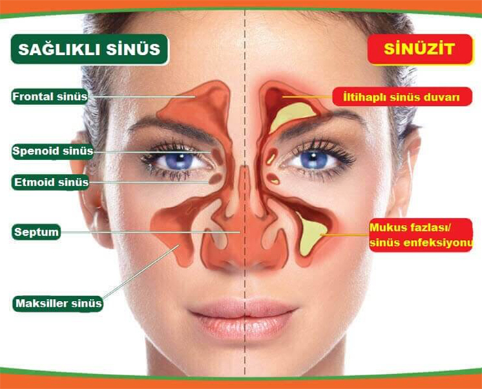 Sinüs Sağlığını Anlamak