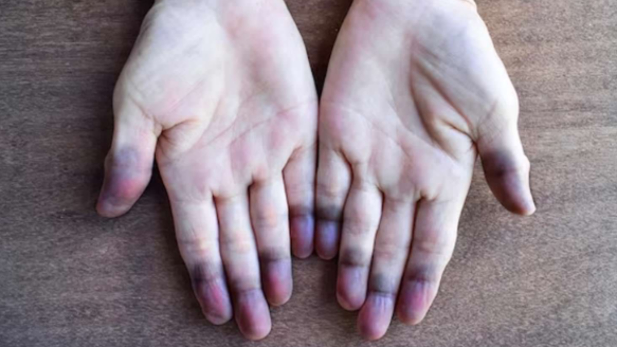 sigara icenler dikkat bu hastalik sinsi ilerliyor doku kaybina neden oluyor xpeWC1p4